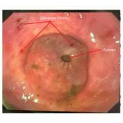 An equine glandular ulcer